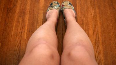 Why You Keep Finding Unexplained Bruises On Your Body