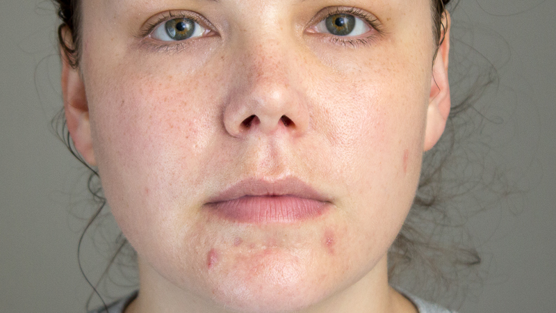 The Best Way To Conceal Dark Spots And Blemishes