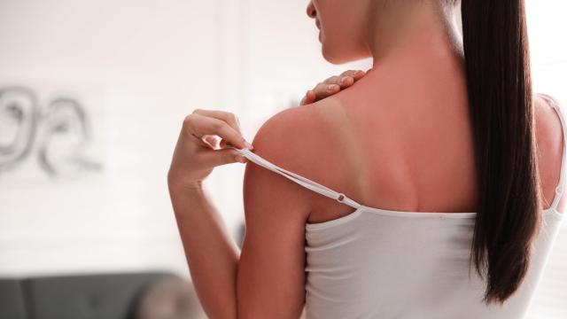 How to Tell If Your Sunburn Might Actually Need Medical Attention