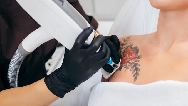 How Hard (and Painful) Is It to Get a Tattoo Removed?
