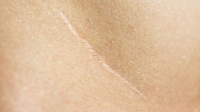 How to Treat Scars at Home and Help Them Disappear