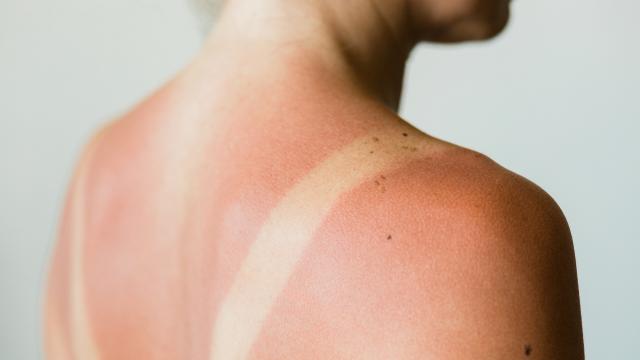 How Long Does It Take for Skin to Repair After Sun Exposure?