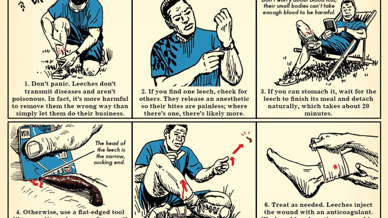 How To Remove A Leech Properly [Infographic]