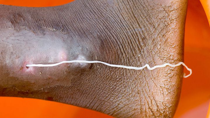 Today I Discovered The Metre-Long Worm That Burns A Hole In Human Feet