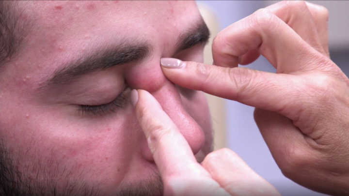 The Proper Way To Pop A Pimple