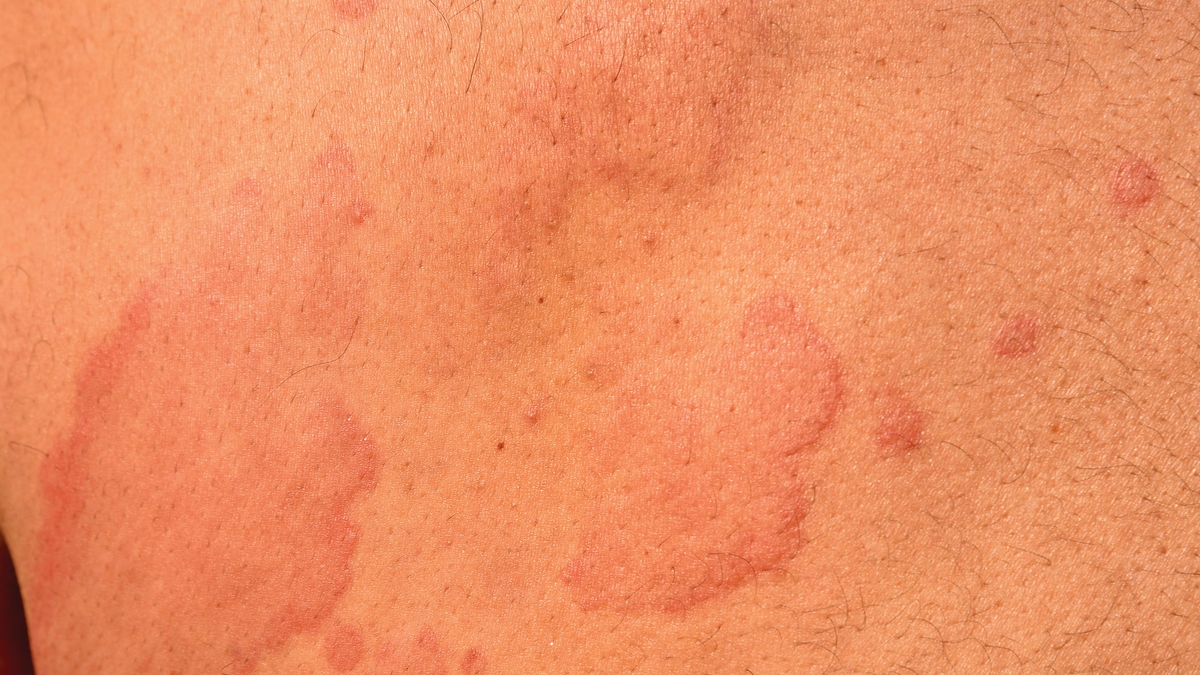 What Are Hives? The Common Skin Condition Giving You Itchy, Red Bumps