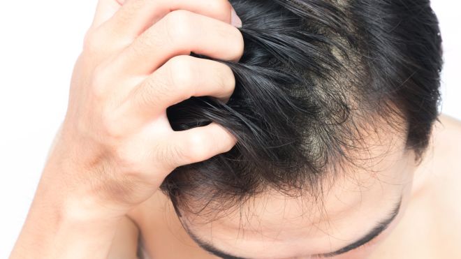 How to Exfoliate Your Scalp to Stay Flake-Free