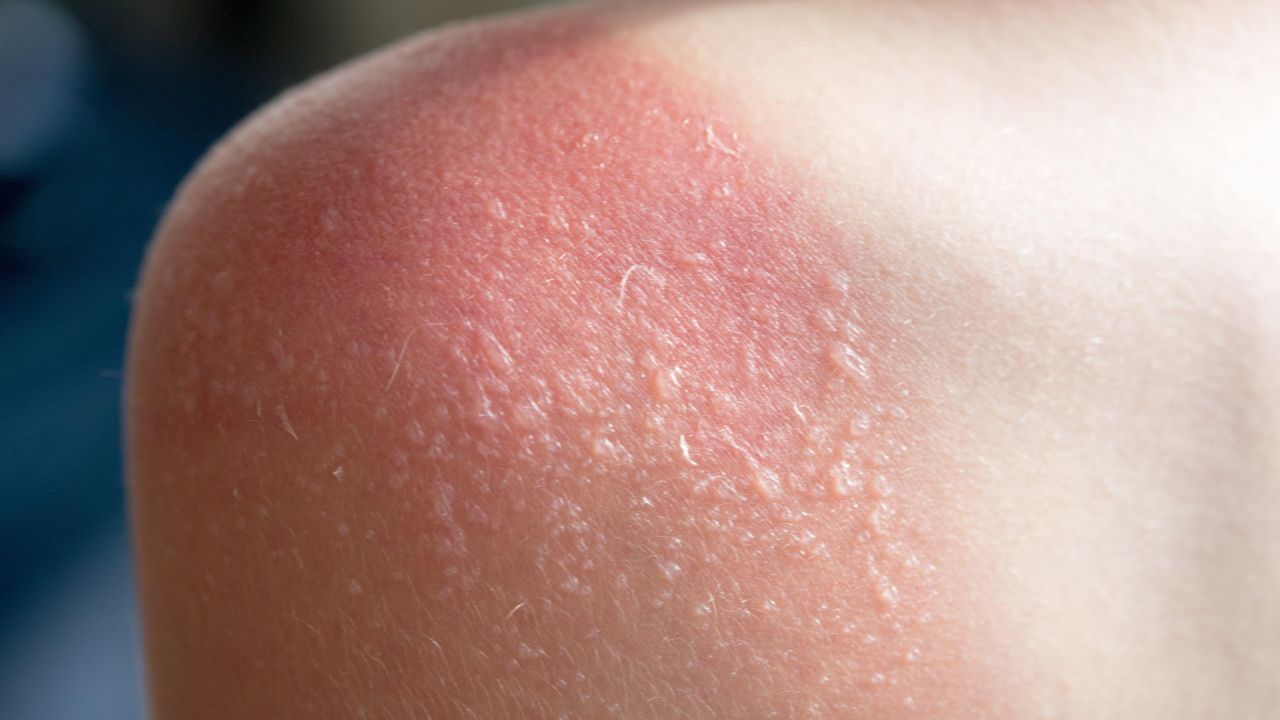 Stop Popping Your Sunburn Blisters