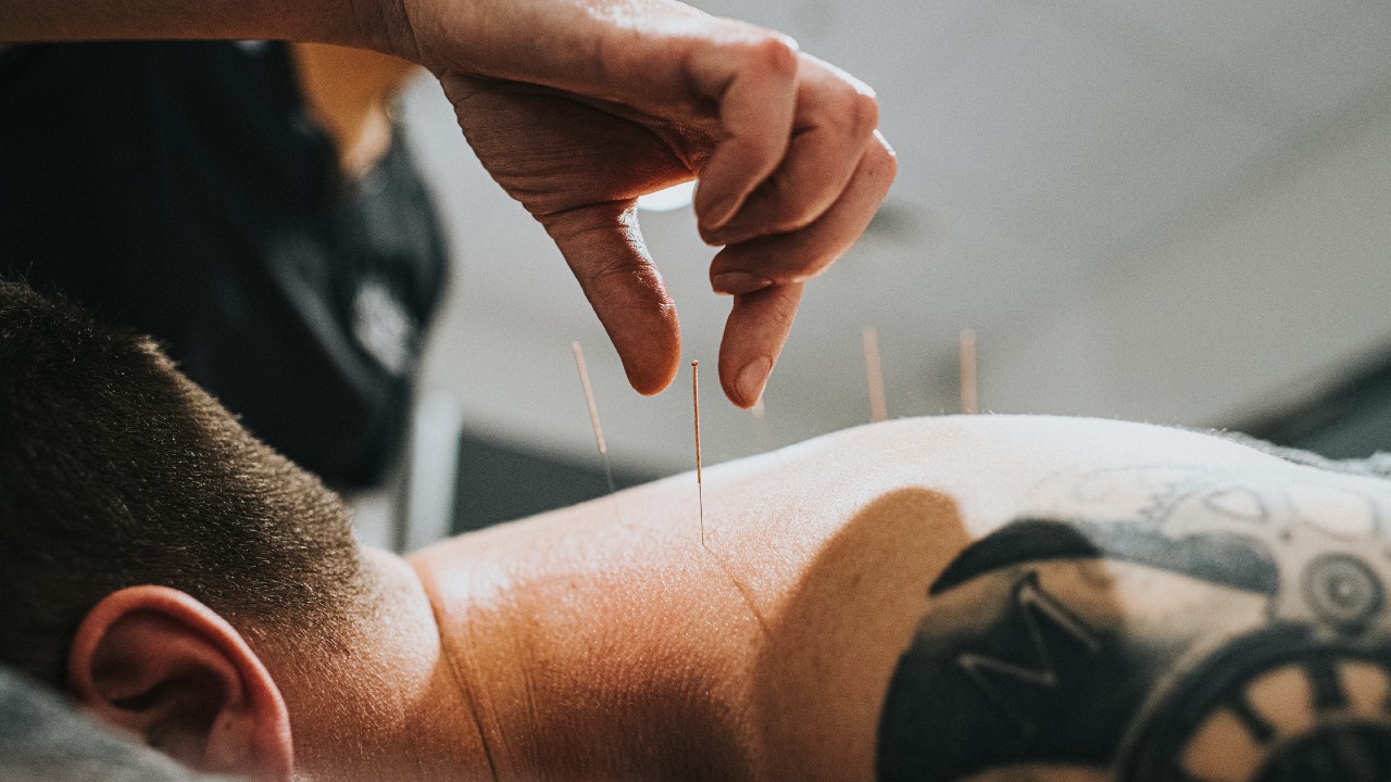 What’s the Difference between ‘Dry Needling’ and Acupuncture?