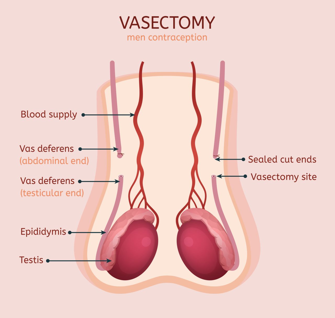 Everything There Is to Know About Getting a Vasectomy
